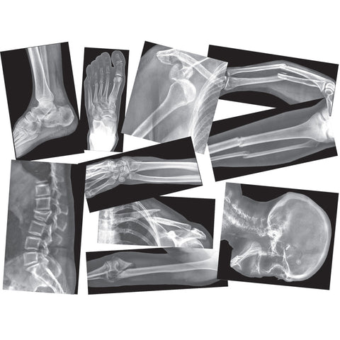 Roylco Broken Bones X-Ray Set, 15/Pack